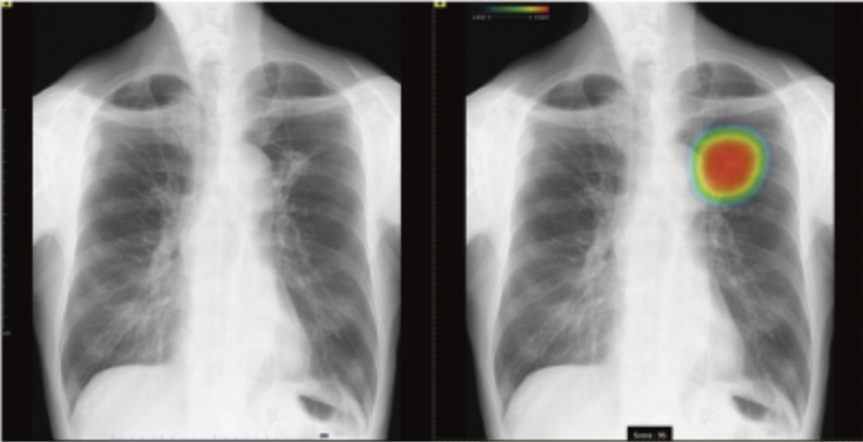 AI技術を用いたレントゲン検査(CXR-AID)を開始しました